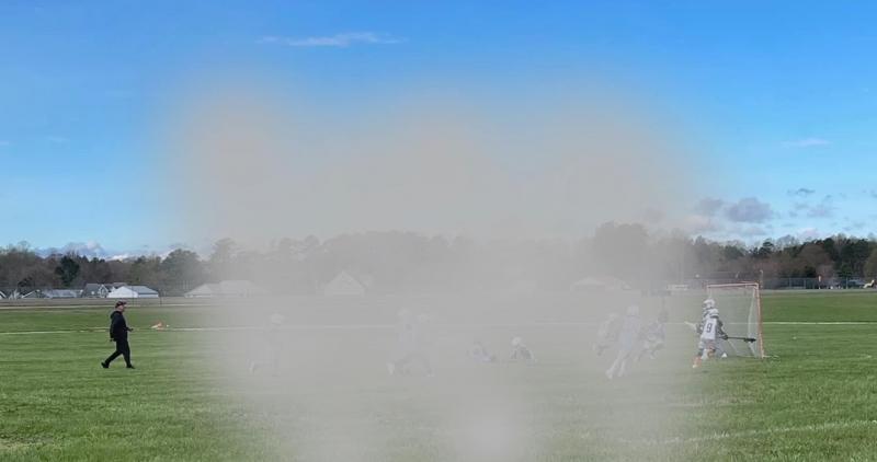 This photo of Napolitano’s son playing lacrosse has been altered to show how Napolitano’s blind spots affect her vision. “I can catch movement on the field, but cannot make any distinction between the players,” she said. “Since I can’t see the game, I listen. I listen to every cheer a fan makes. When there’s a goal and people clap, I clap even harder. I am there. To my kids, that is what’s most important.”